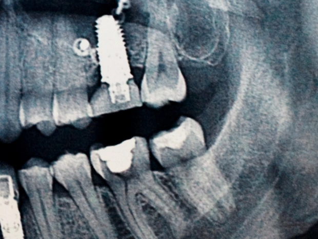 zdjęcie rentgenowskie implantu zęba